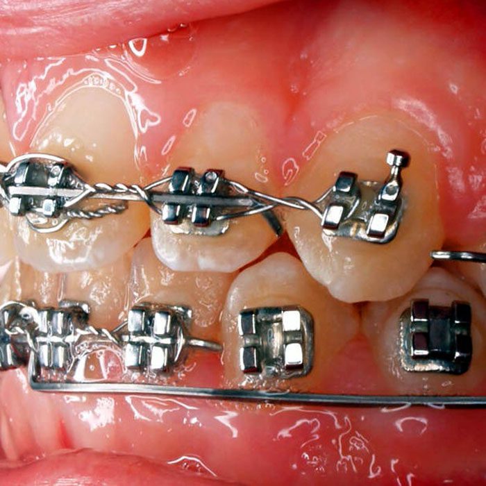 braces anatomy 2022 700 Wheeler Orthodontics